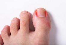 How to Heal a Toe Infection