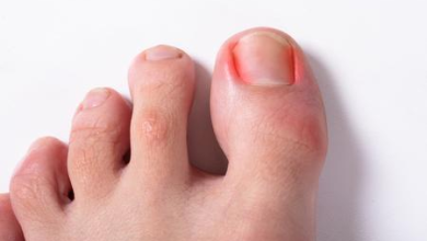 How to Heal a Toe Infection