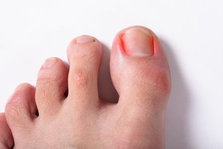 How to Heal a Toe Infection