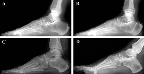 Where To Find Expert Calcaneus Osteotomy Care In Scottsdale